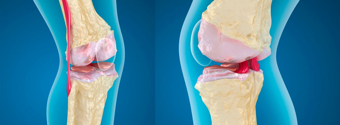 Lesiones de cartílago en rodilla - Dr. Esteban Castro - Médico Traumatólogo Ortopédista | Cirugía de columna y articular