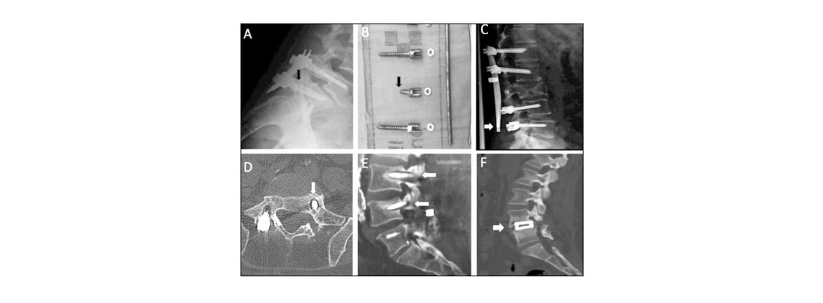 Dr. Esteban Castro - Ortopedia y traumatología Artrodesis vertebral posterior