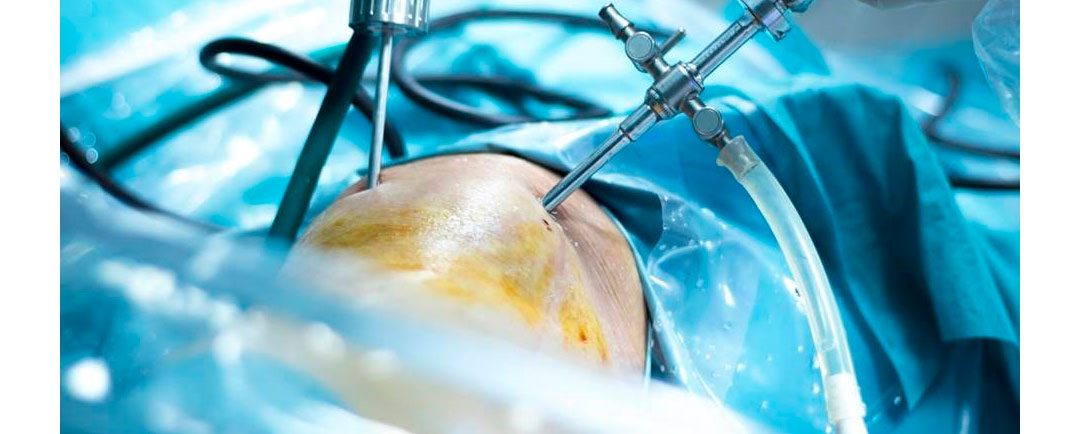 Los nuevos avances de la cirugía artroscópica