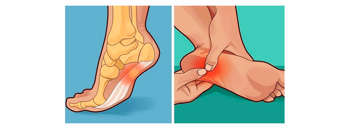 Fascitis Plantar