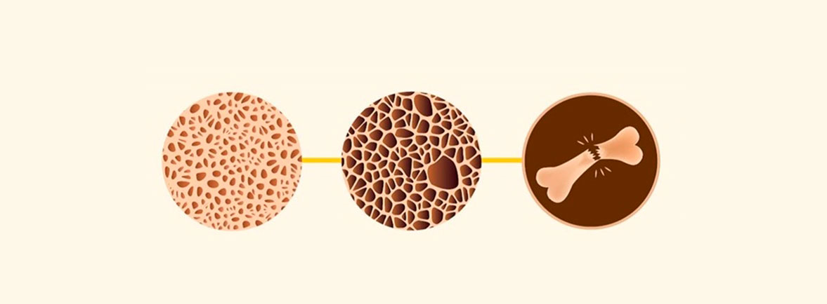 La Osteoporosis