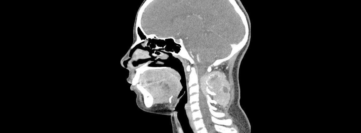 sarcoma melanotico en el cuello Mdico extrae tumor del tamao de un meln del de un hombre Sarcoma sinovial gigante del cuello.