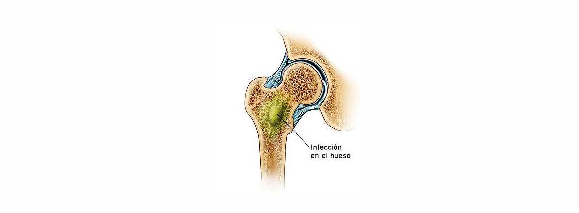 Osteomielitis hematogena