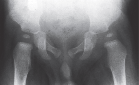 Artritis séptica - Dr. Esteban Castro - Médico Traumatólogo Ortopédista | Cirugía de columna y articular