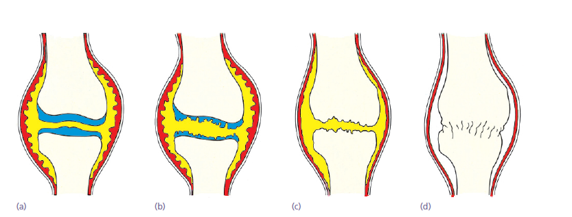 Artritis séptica - Dr. Esteban Castro - Médico Traumatólogo Ortopédista | Cirugía de columna y articular