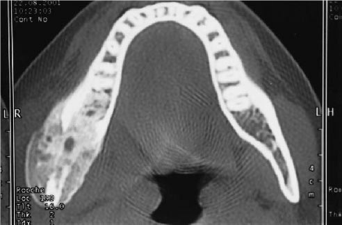 Osteomielitis esclerosante de garré - Dr. Esteban Castro - Médico Traumatólogo Ortopédista | Cirugía de columna y articular
