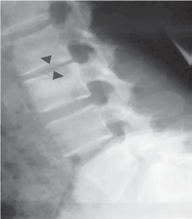 Brucellosis y lumbalgia (dolor en zona lumbar de columna) - Dr. Esteban Castro - Médico Traumatólogo Ortopédista | Cirugía de columna y articular