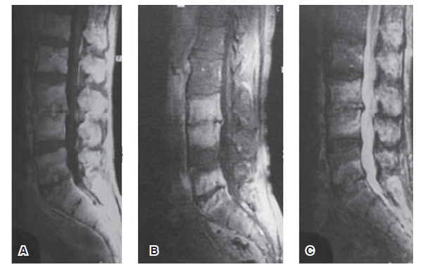 Dr. Esteban Castro - Ortopedia y traumatología Brucellosis y lumbalgia (dolor en zona lumbar de columna)