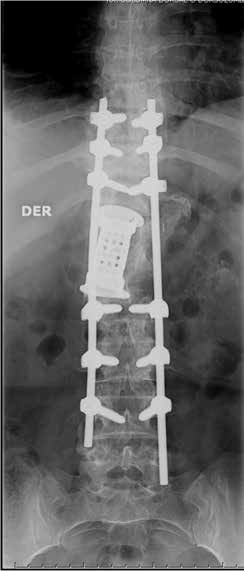 Hidatidosis vertebral - Dr. Esteban Castro - Médico Traumatólogo Ortopédista | Cirugía de columna y articular
