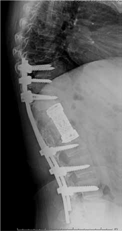 Hidatidosis vertebral - Dr. Esteban Castro - Médico Traumatólogo Ortopédista | Cirugía de columna y articular