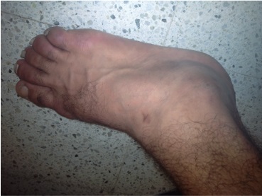 Esguince de tobillo - Dr. Esteban Castro - Médico Traumatólogo Ortopédista | Cirugía de columna y articular