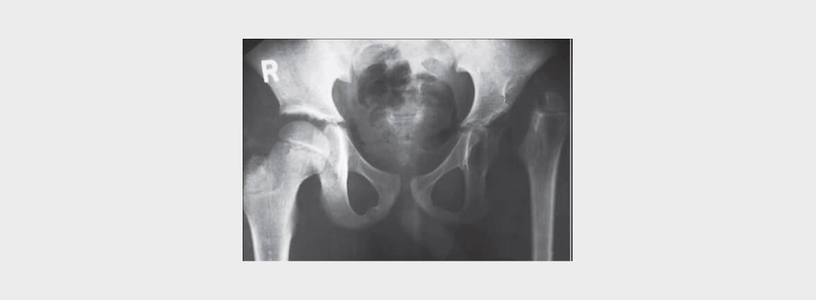 ARTRITIS SÉPTICA