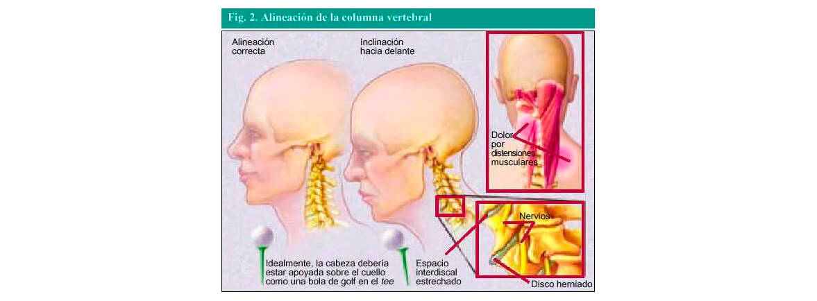 Cervicalgia, Lesión de músculos de cuello