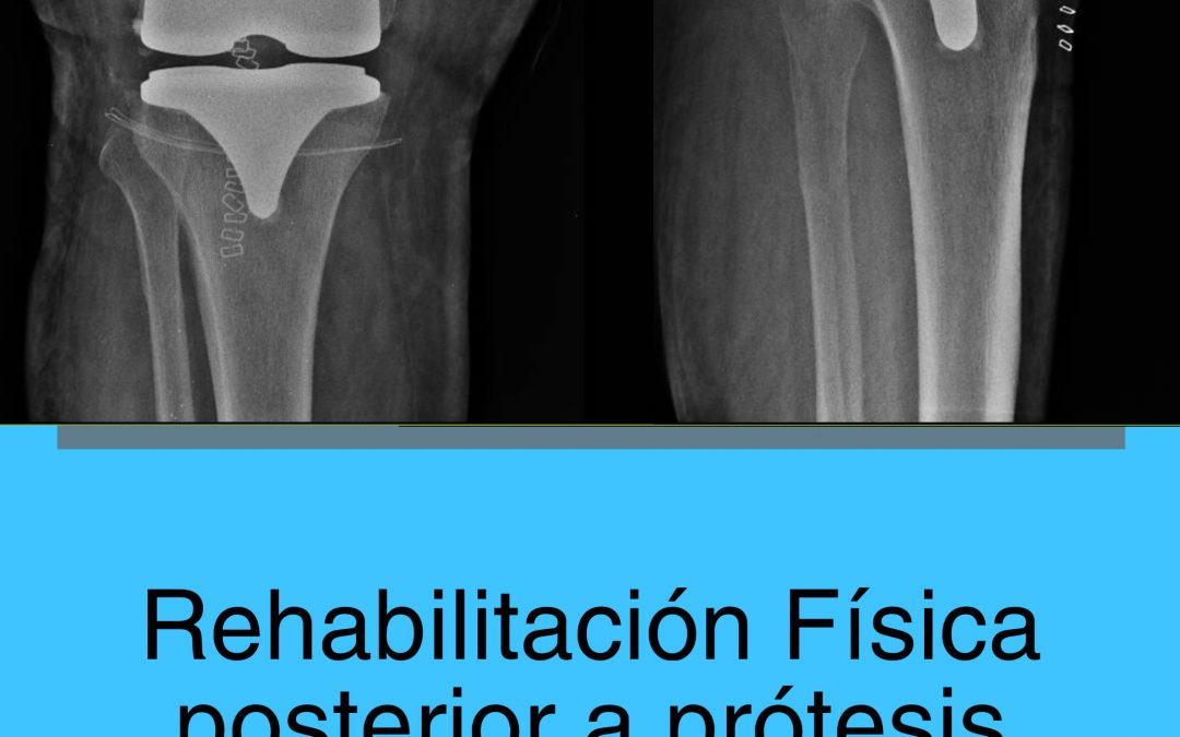 Ejercicios de Rehabilitación Física Posterior a Artroplastía (prótesis) de Rodilla