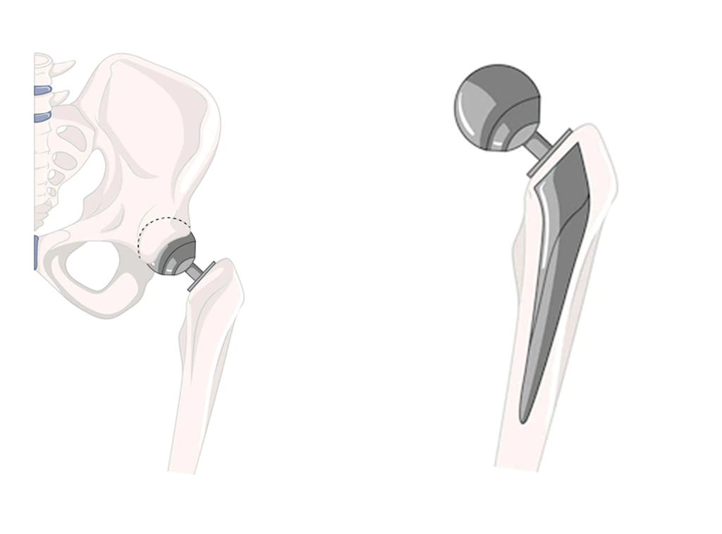 Cirugía de cadera en guadalajara - Dr. Esteban Castro - Médico Traumatólogo Ortopédista | Cirugía de columna y articular