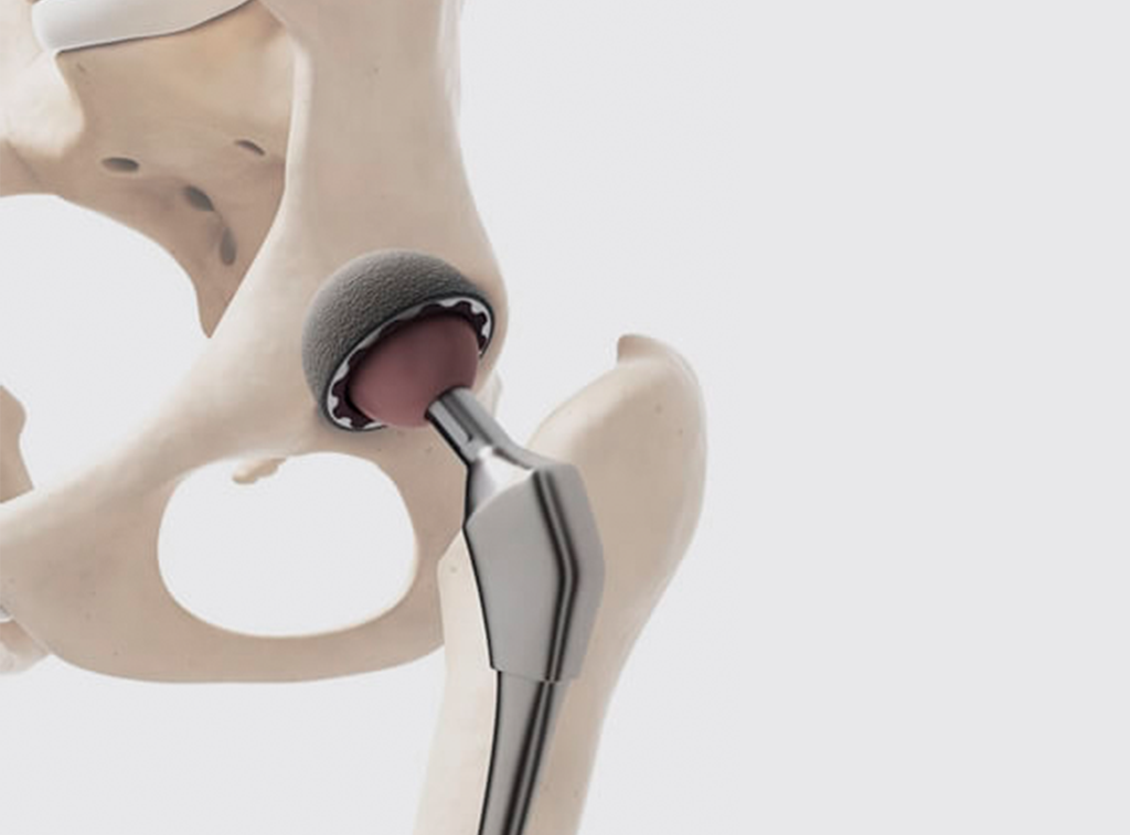 Cirugía de cadera en guadalajara - Dr. Esteban Castro - Médico Traumatólogo Ortopédista | Cirugía de columna y articular