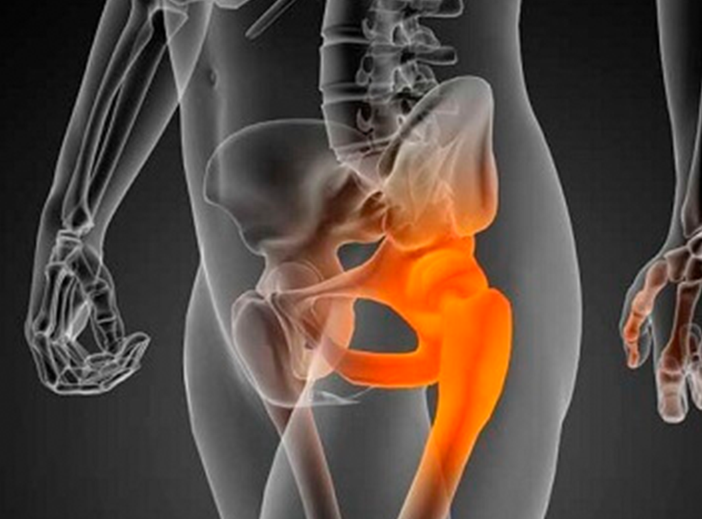 Cirugía de cadera en guadalajara - Dr. Esteban Castro - Médico Traumatólogo Ortopédista | Cirugía de columna y articular