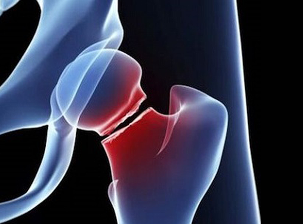 Cirugía de cadera en guadalajara - Dr. Esteban Castro - Médico Traumatólogo Ortopédista | Cirugía de columna y articular