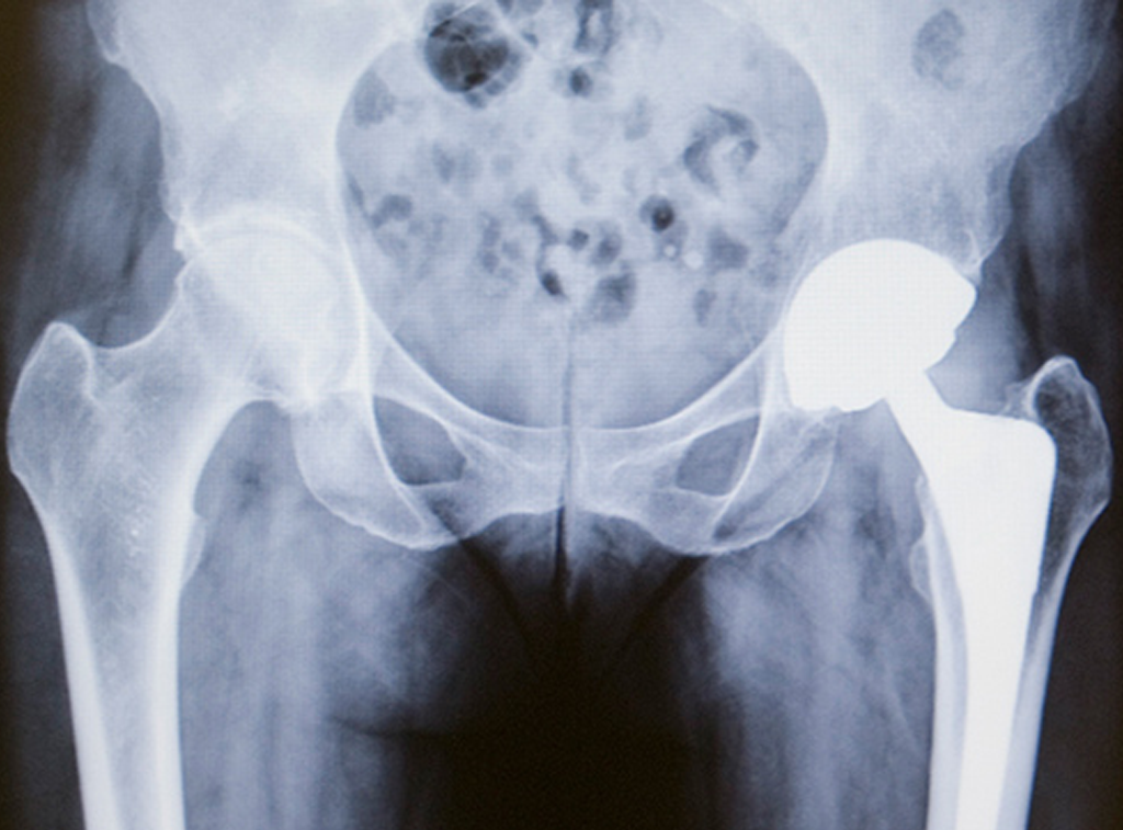 Cirugía de cadera en guadalajara - Dr. Esteban Castro - Médico Traumatólogo Ortopédista | Cirugía de columna y articular