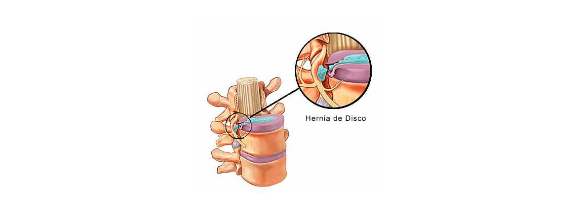 Hernia de disco cervical