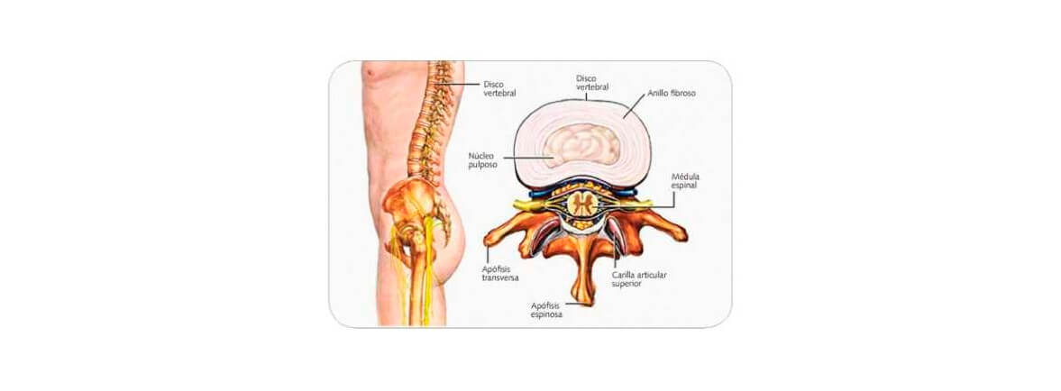 Hernia de disco lumbar