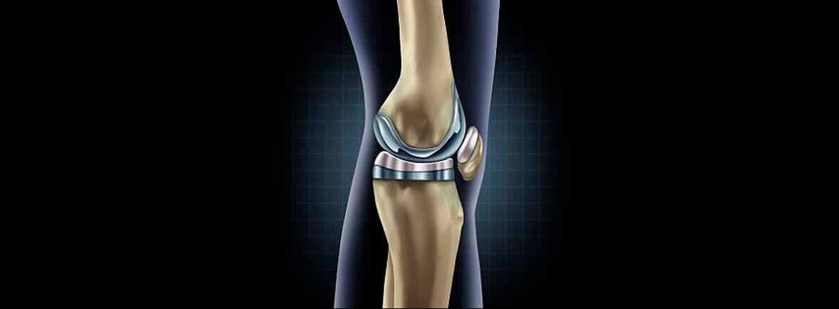Las inyecciones de corticosteroides intraarticulares aumentan el riesgo de requerir una artroplastia de rodilla