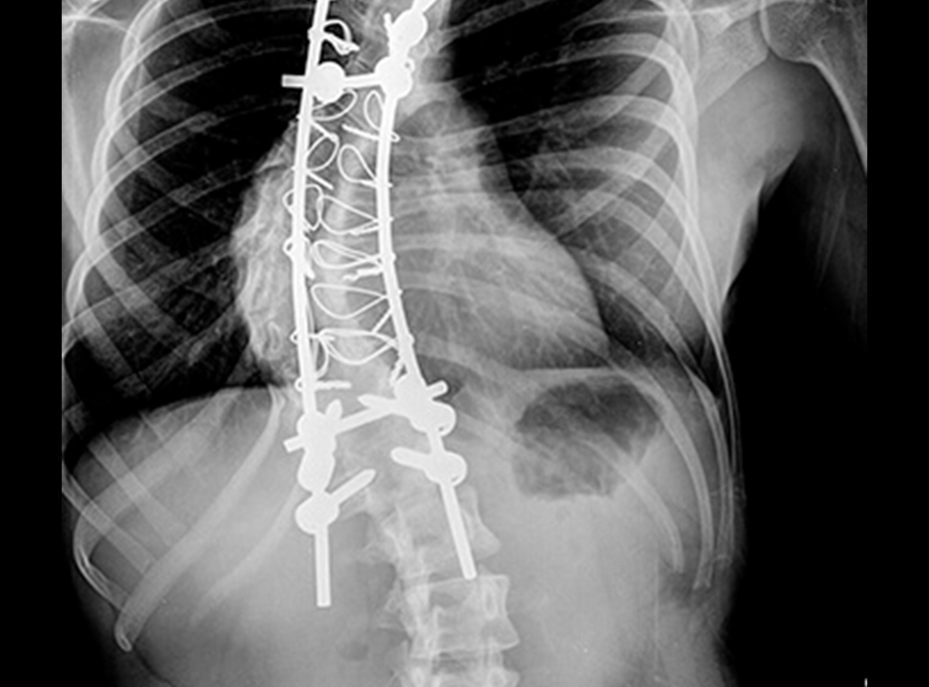 Cirugía de columna en guadalajara - Cirugía Ortopédica y Traumatología Cirugía de columna en guadalajara - Dr. Esteban Castro - Médico Traumatólogo Ortopédista | Cirugía de columna y articular