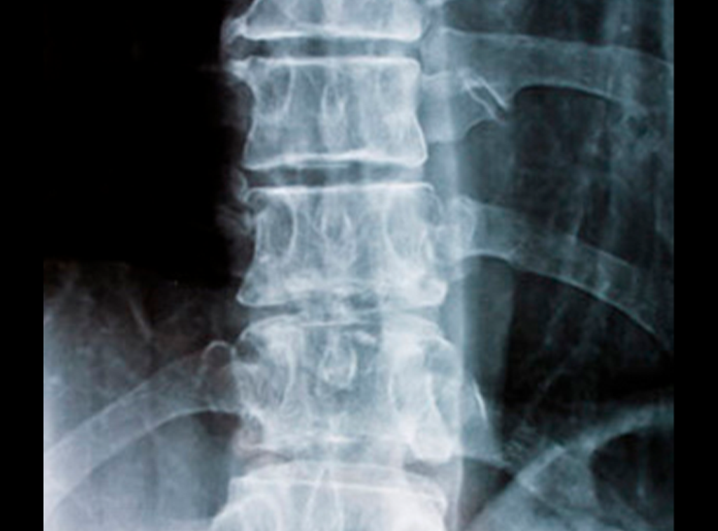 Cirugía de columna en guadalajara - Cirugía Ortopédica y Traumatología Cirugía de columna en guadalajara - Dr. Esteban Castro - Médico Traumatólogo Ortopédista | Cirugía de columna y articular