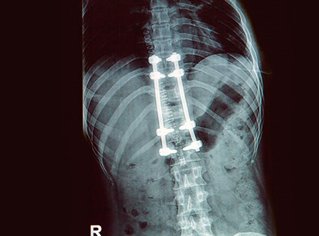 Cirugía de columna en guadalajara - Cirugía Ortopédica y Traumatología Cirugía de columna en guadalajara - Dr. Esteban Castro - Médico Traumatólogo Ortopédista | Cirugía de columna y articular