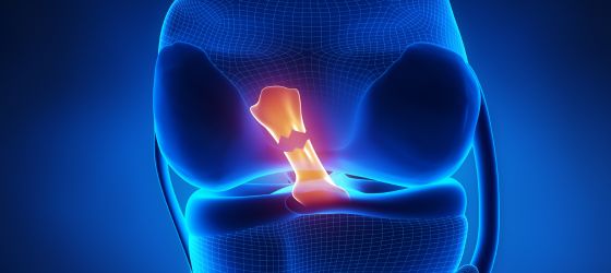 Todo lo que el paciente debe de saber antes de realizar una reparación de ligamento cruzado anterior de rodilla