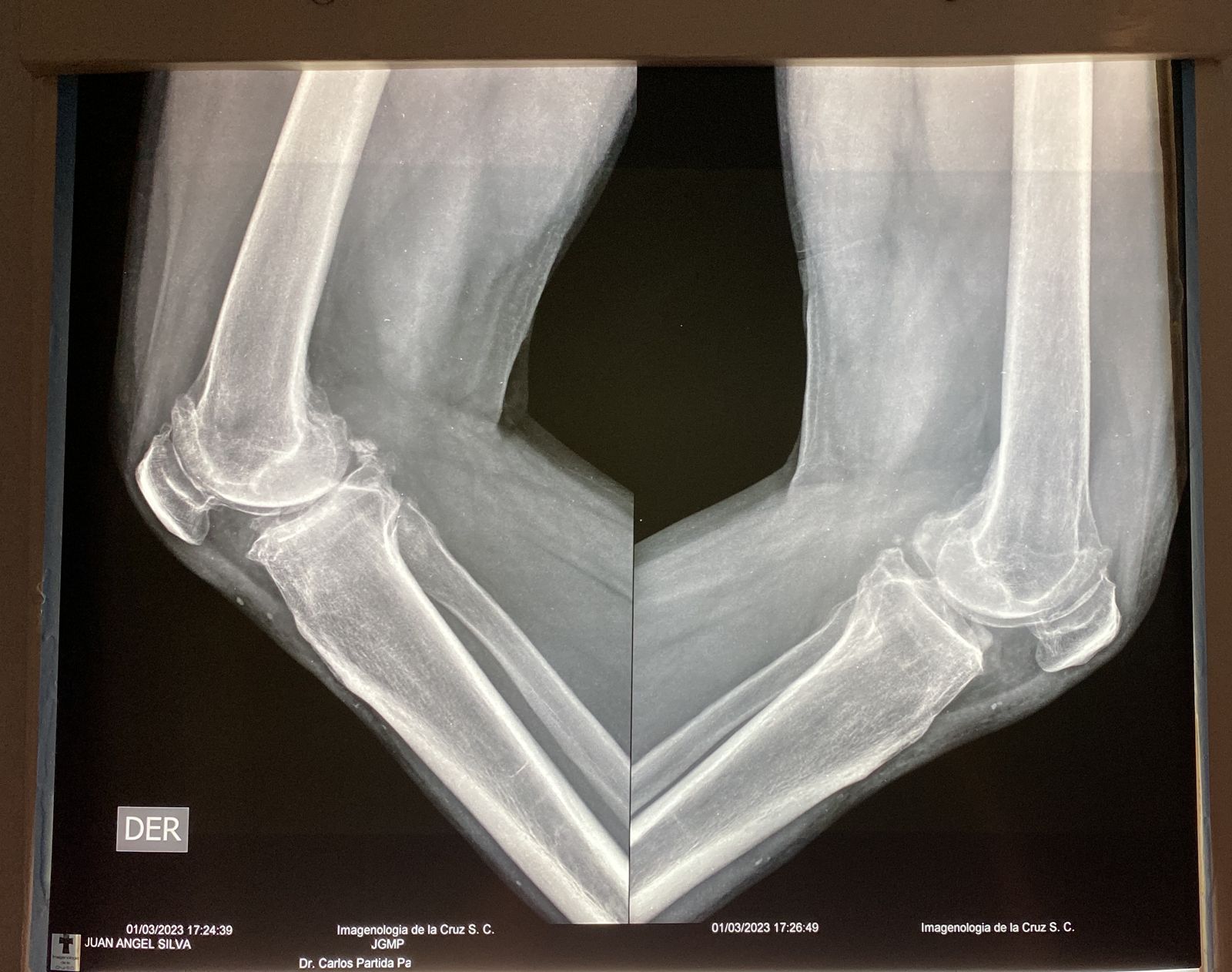 Que es el desgaste de rodilla o gonartrosis - Cirugía de rodilla Guadalajara