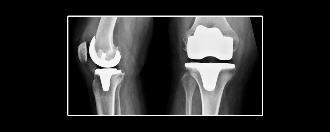 Complicaciones tromboembólicas y hemorrágicas después de una artroplastia total de rodilla primaria: Un estudio de cohorte nacional danés