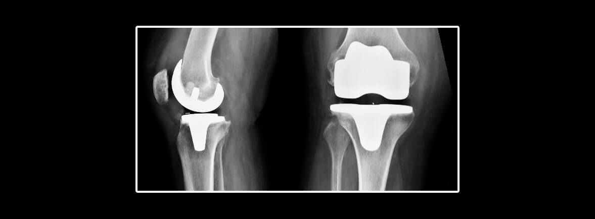 artroplastia total de rodilla primaria