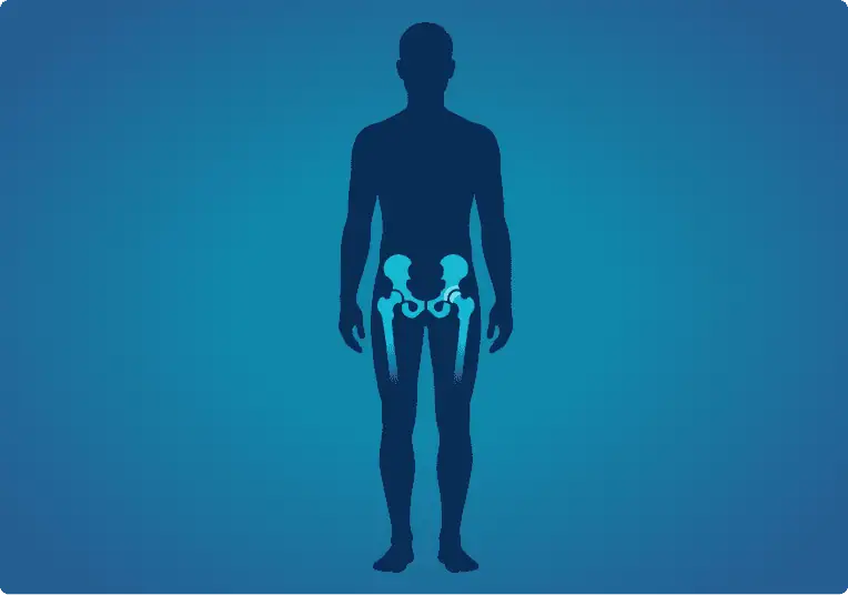 Ilustración de la articulación de la cadera