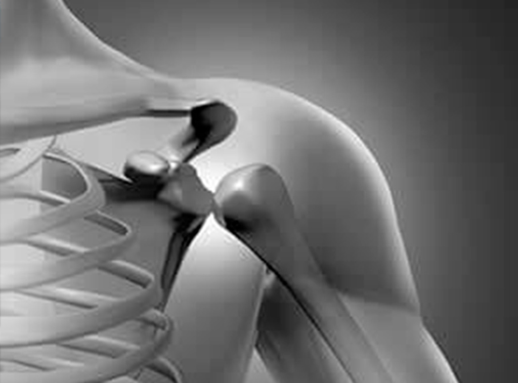 Cirugía de hombro en guadalajara - Cirugía Ortopédica y Traumatología Cirugía de hombro en guadalajara - Dr. Esteban Castro - Médico Traumatólogo Ortopédista | Cirugía de columna y articular