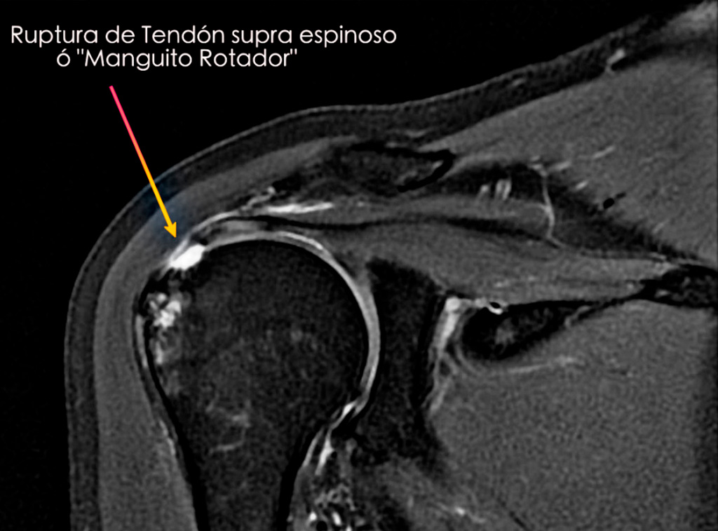 Cirugía de hombro en guadalajara - Cirugía Ortopédica y Traumatología Cirugía de hombro en guadalajara - Dr. Esteban Castro - Médico Traumatólogo Ortopédista | Cirugía de columna y articular