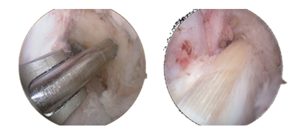 Todo lo que el paciente debe de saber antes de realizar una reparación de ligamento cruzado anterior de rodilla - Dr. Esteban Castro - Médico Traumatólogo Ortopédista | Cirugía de columna y articular