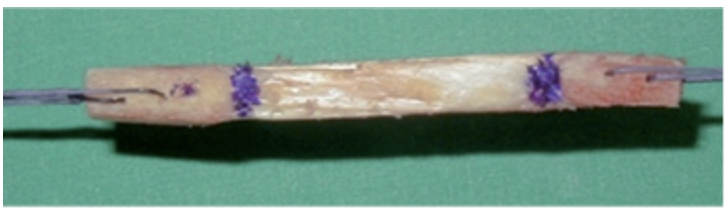 Todo lo que el paciente debe de saber antes de realizar una reparación de ligamento cruzado anterior de rodilla - Dr. Esteban Castro - Médico Traumatólogo Ortopédista | Cirugía de columna y articular