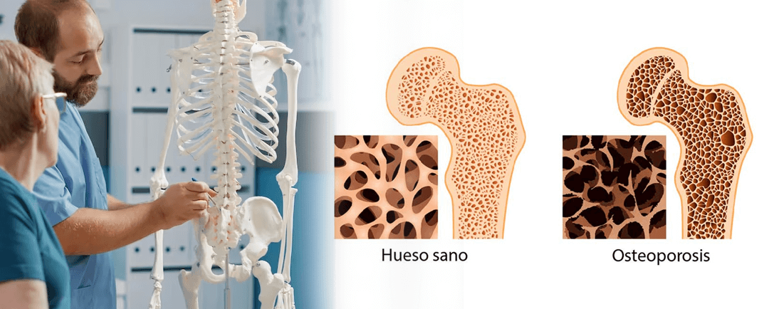 Consecuencias de la osteoporosis