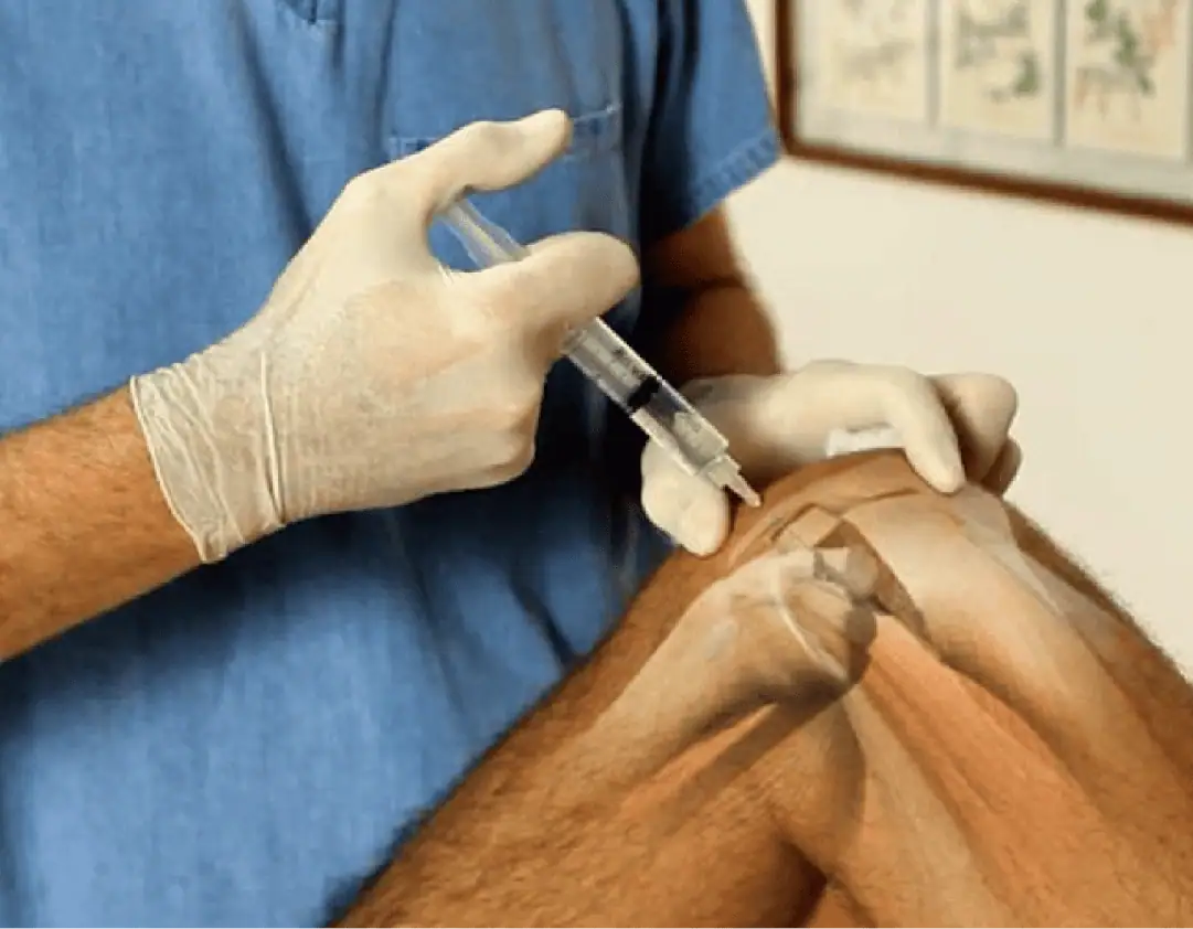 Inyección en la rodilla como tratamiento sin cirugía