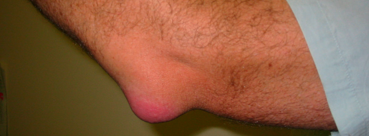 Bursitis - Bursitis: Es una inflamación de las bolsas; es necesario saber que el cuerpo humano tiene muchas bolsas en diferentes partes del aparato locomotor. Bursitis - Dr. Esteban Castro - Médico Traumatólogo Ortopédista | Cirugía de columna y articular