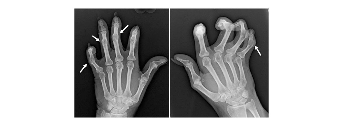 Tratamientos de la Artrosis - Dr. Esteban Castro - Médico Traumatólogo Ortopédista | Cirugía de columna y articular