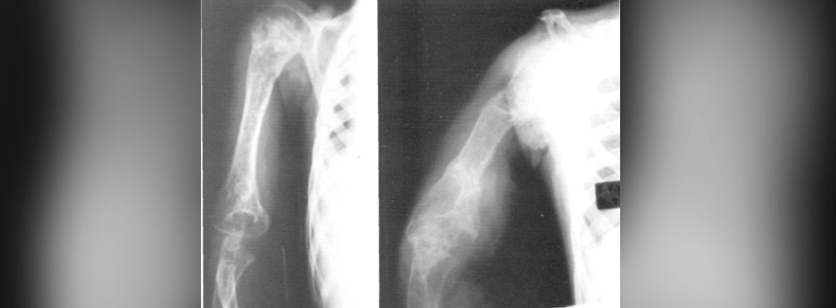 Angiomatosis quistica ósea - Dr. Esteban Castro - Médico Traumatólogo Ortopédista | Cirugía de columna y articular