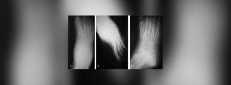 ANALGESIA CONGENITA Y FRACTURAS
