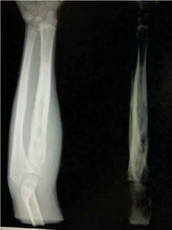 Enfermedad de caffey - Dr. Esteban Castro - Médico Traumatólogo Ortopédista | Cirugía de columna y articular