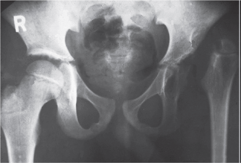 Artritis séptica - Dr. Esteban Castro - Médico Traumatólogo Ortopédista | Cirugía de columna y articular