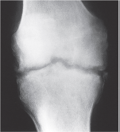 Artritis séptica - Dr. Esteban Castro - Médico Traumatólogo Ortopédista | Cirugía de columna y articular