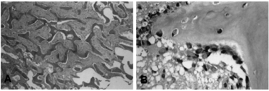 Osteomielitis esclerosante de garré - Dr. Esteban Castro - Médico Traumatólogo Ortopédista | Cirugía de columna y articular