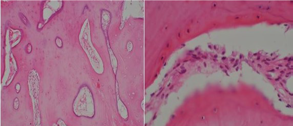 Osteomielitis esclerosante de garré - Dr. Esteban Castro - Médico Traumatólogo Ortopédista | Cirugía de columna y articular