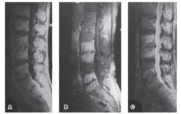 Brucellosis y lumbalgia (dolor en zona lumbar de columna) - Dr. Esteban Castro - Médico Traumatólogo Ortopédista | Cirugía de columna y articular